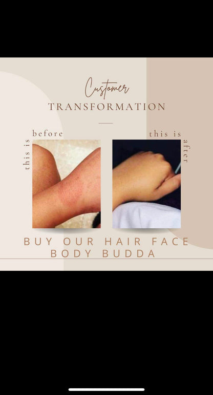 Eczema & Psoriasis Face, Hair, Body Budda